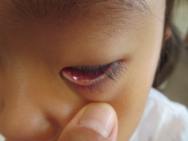目 眼帯 はやり 感染性結膜炎・流行性角結膜炎（はやり目）｜新宿眼科クリニック
